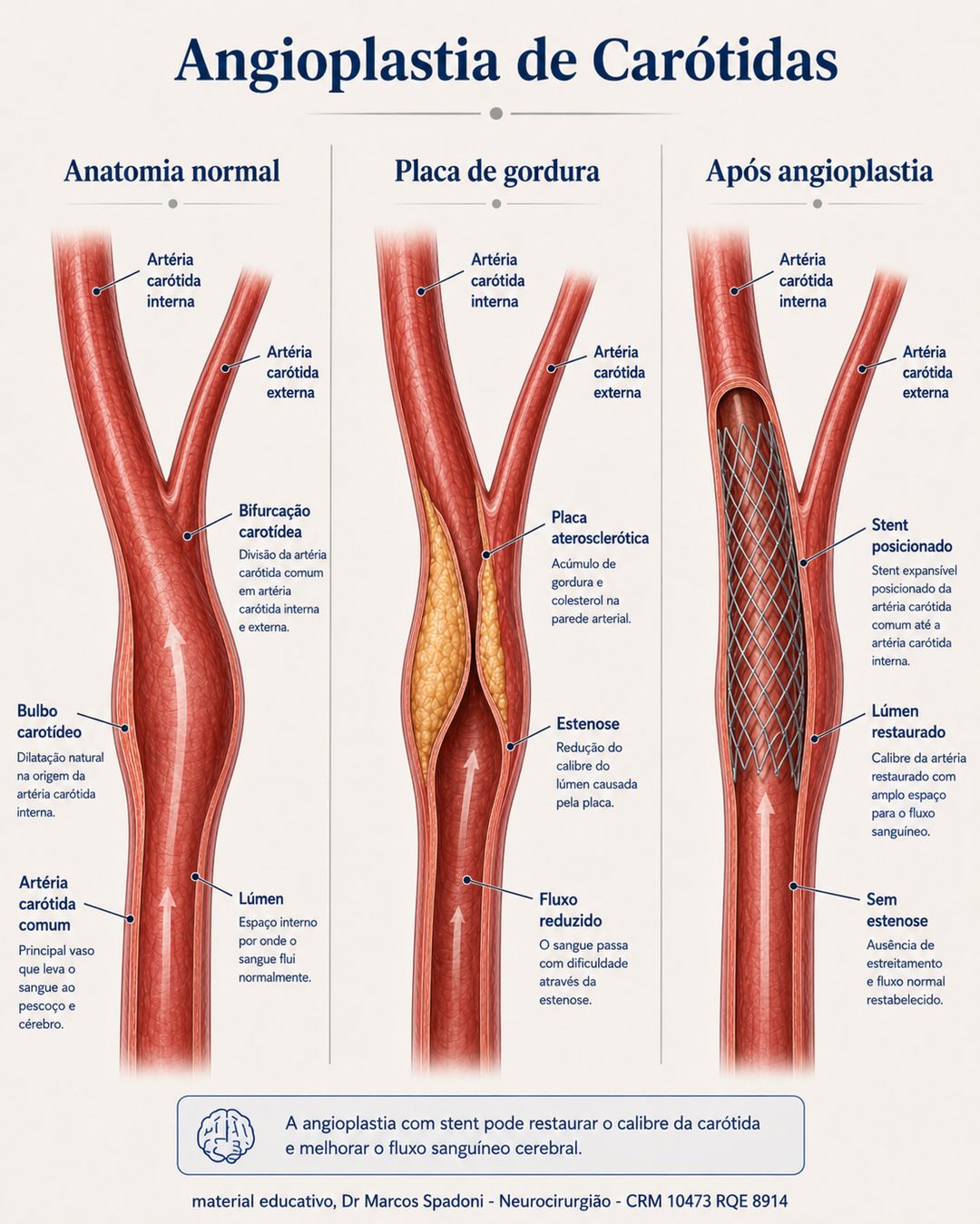 Diagrama da angioplastia de carótida em três estágios: anatomia normal, placa de gordura estreitando a artéria e o resultado após a colocação do stent, com o lúmen restaurado
