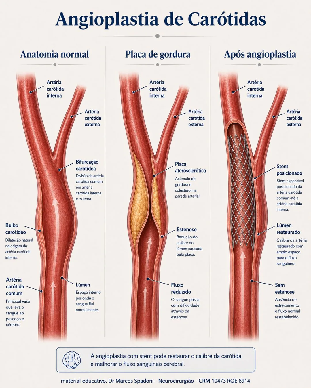 Diagrama da angioplastia de carótida em três estágios: anatomia normal, placa de gordura estreitando a artéria e o resultado após a colocação do stent, com o lúmen restaurado