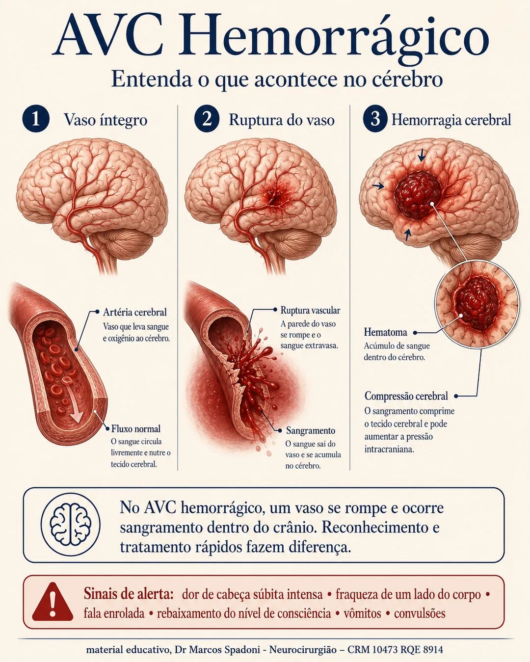 Diagrama do AVC hemorrágico: vaso íntegro, ruptura da parede e a hemorragia dentro do cérebro