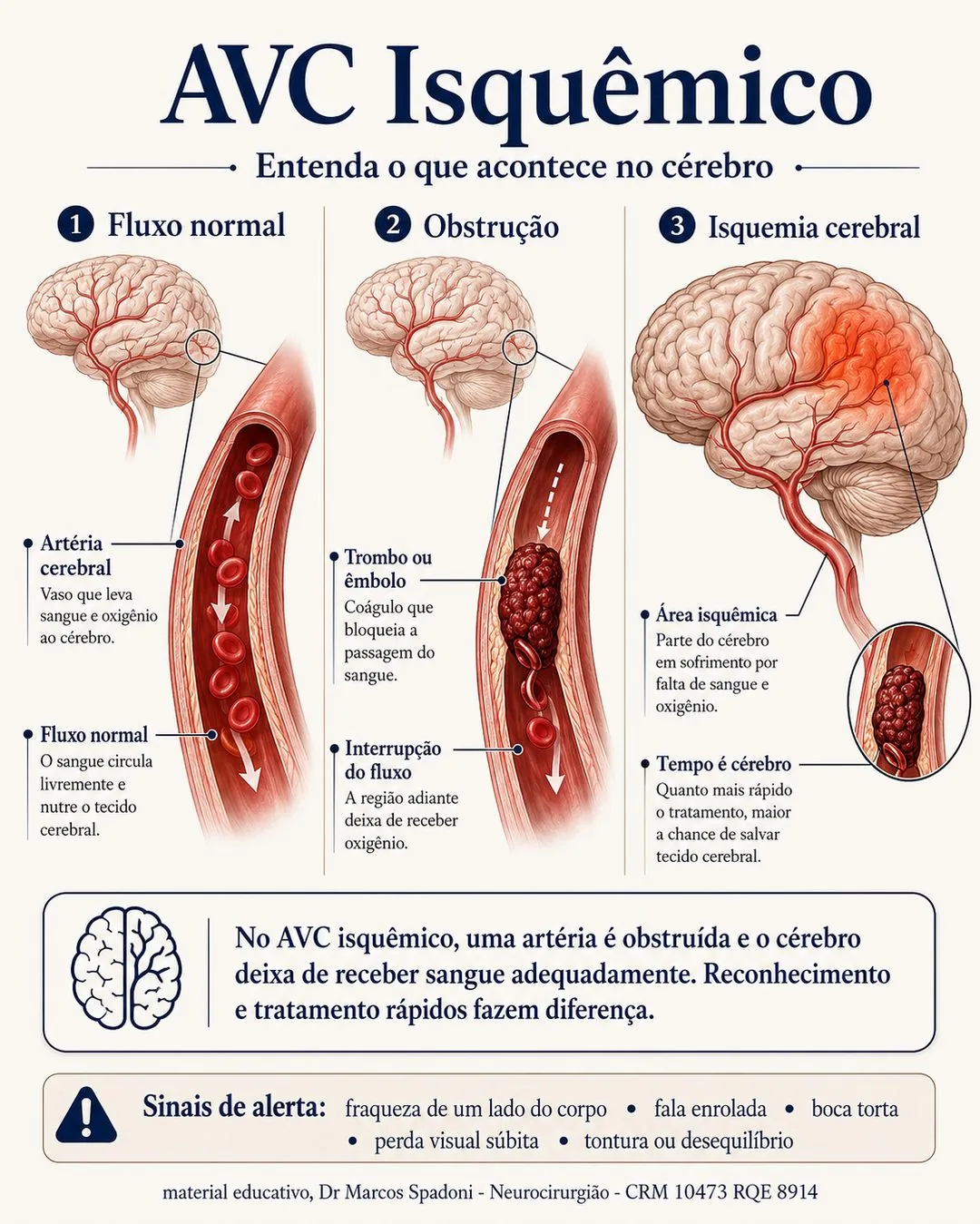 Diagrama do AVC isquêmico: fluxo normal, obstrução por um coágulo e a área do cérebro em isquemia