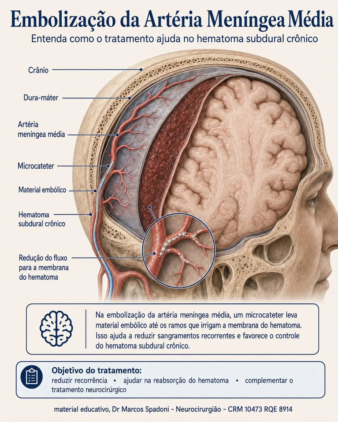 Diagrama da embolização da artéria meníngea média: um microcateter leva material embólico aos ramos que irrigam a membrana do hematoma subdural