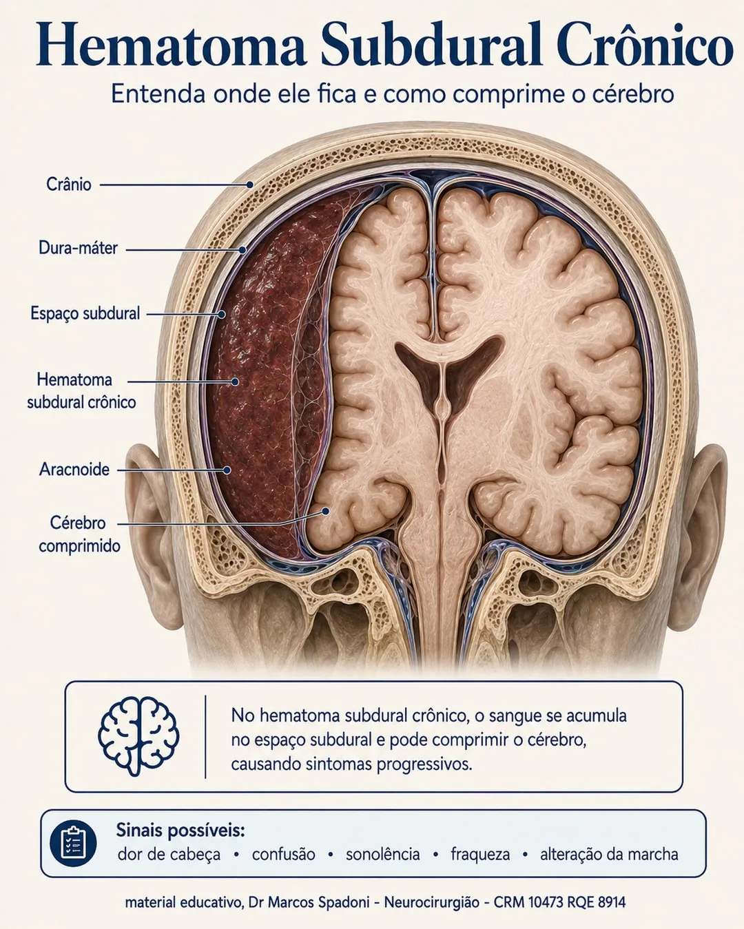 Diagrama do hematoma subdural crônico: o sangue acumulado no espaço subdural comprimindo o cérebro