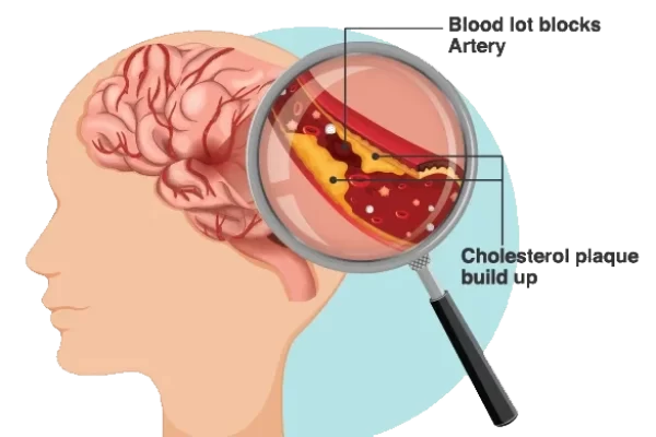 65fd229a0efe5Understanding Ischemic Stroke_Large